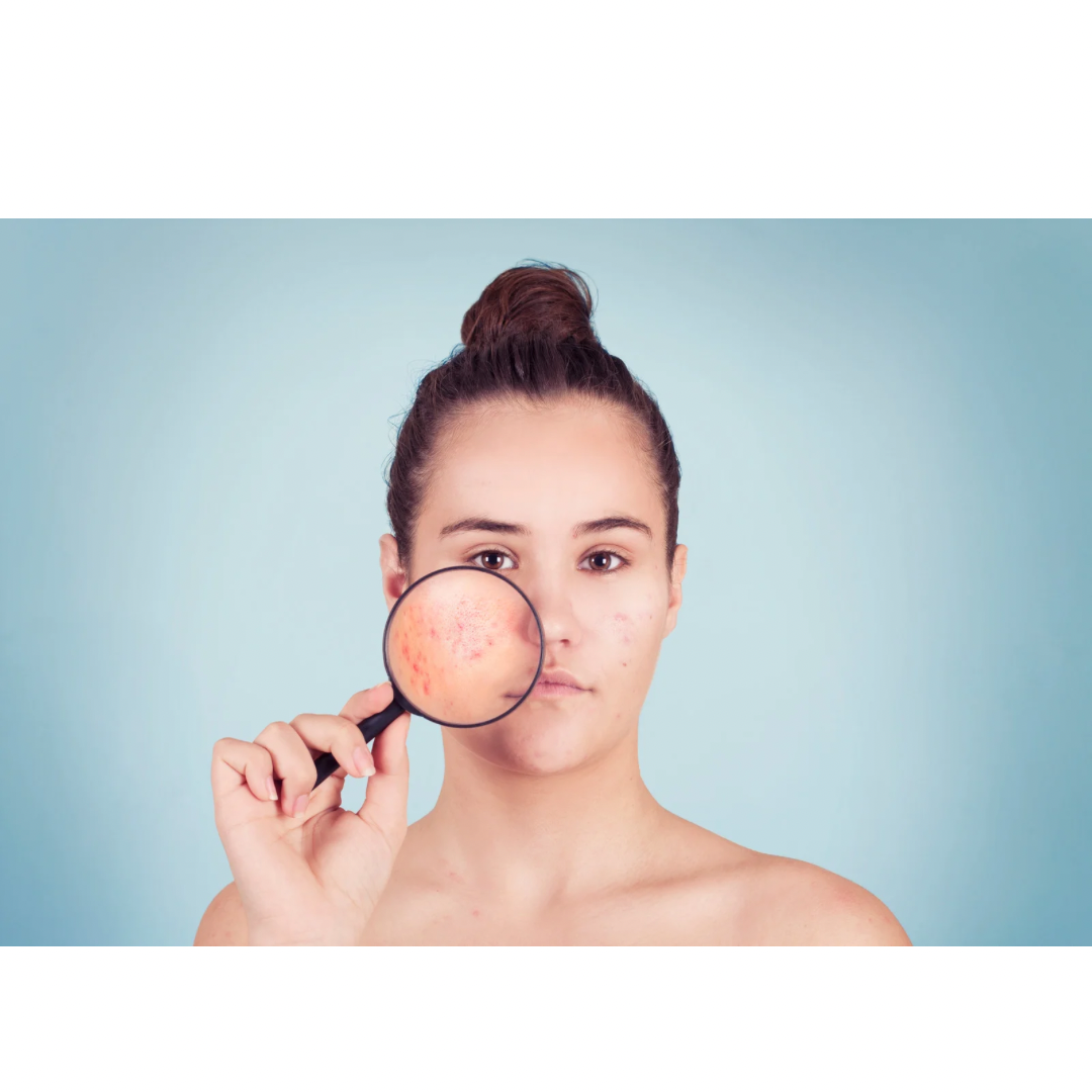 Acné: Evaluación inicial
