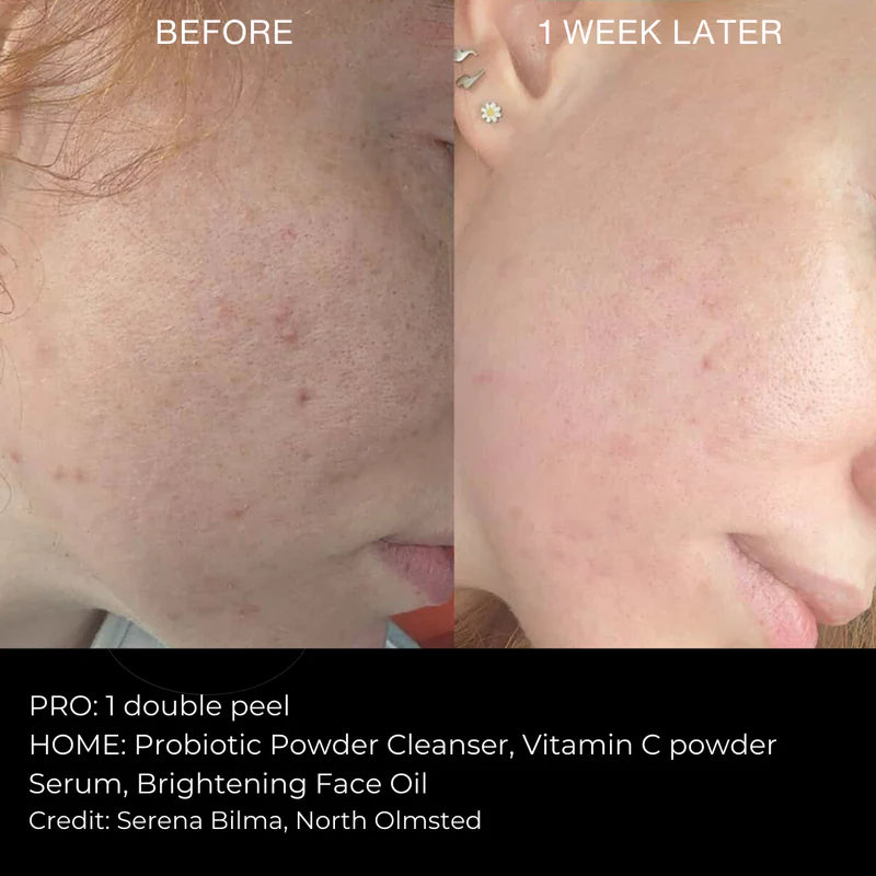 Peeling Avanzado ⚗️ Peeling Natural Mr. Lulú