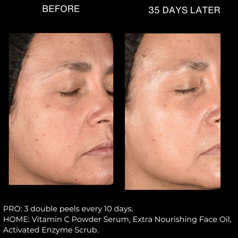 Peeling Avanzado ⚗️ Peeling Natural Mr. Lulú